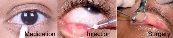 Stye Chalazion